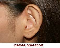 plastic-surgery-prominent-ear 